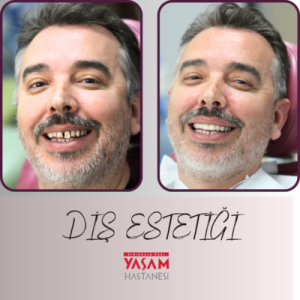 diş estetiği kırıkkale