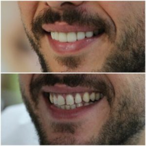diş estetiği öncesi sonrası